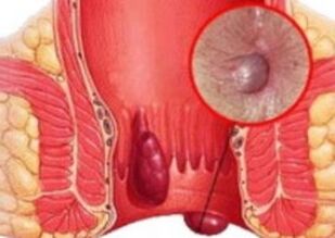 Wat gesäit d'Hämorrhoiden aus
